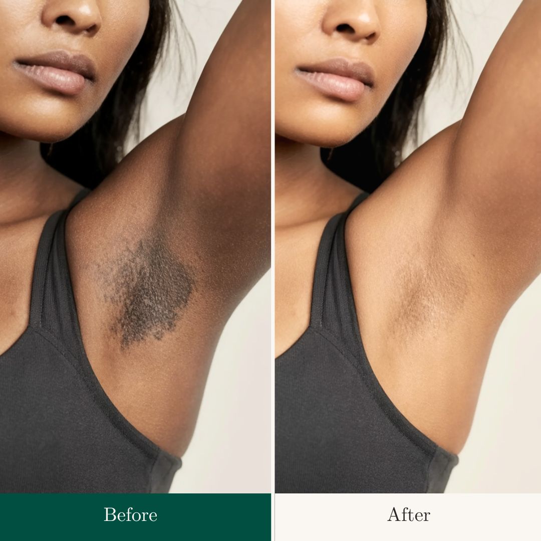 Before After 22